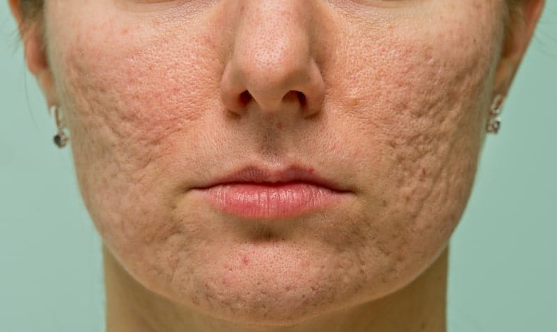 acne scar removal melbourne